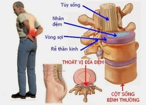 thoát vị đĩa đệm