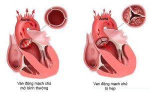 hẹp van động mạch chủ