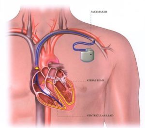 máy tạo nhịp tim